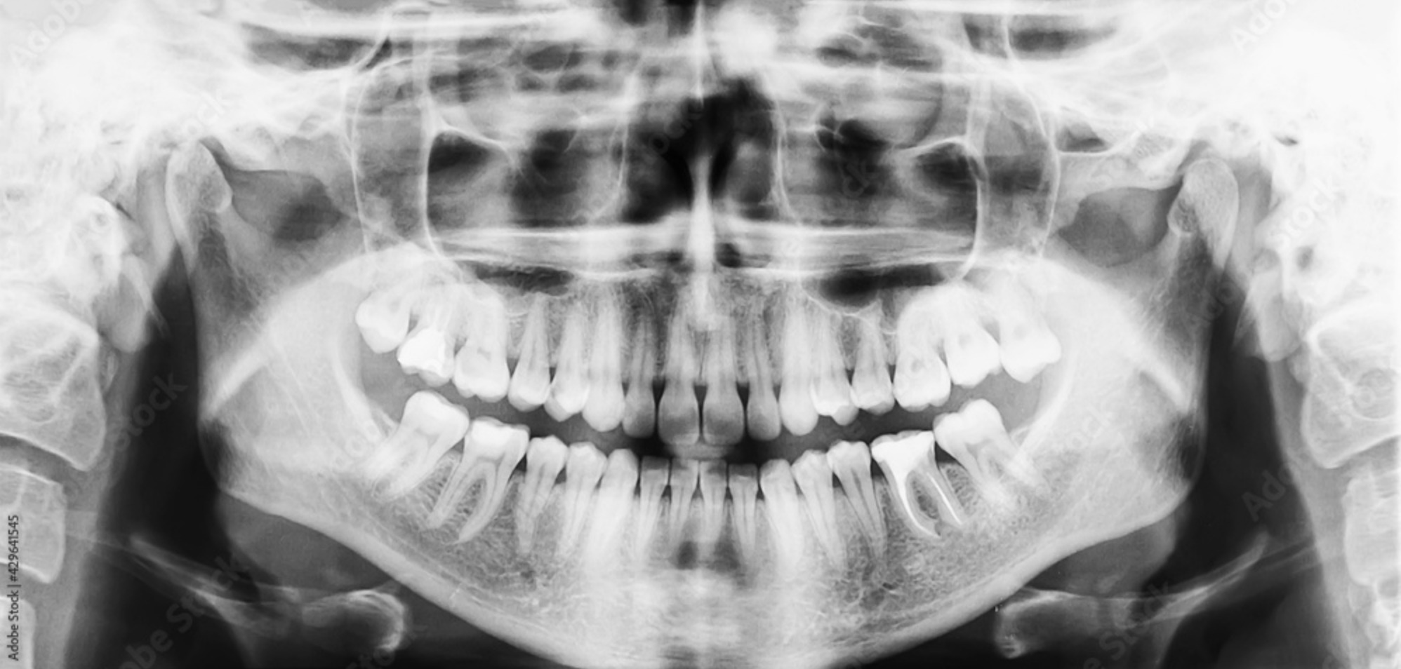 Panoramic dental X-ray