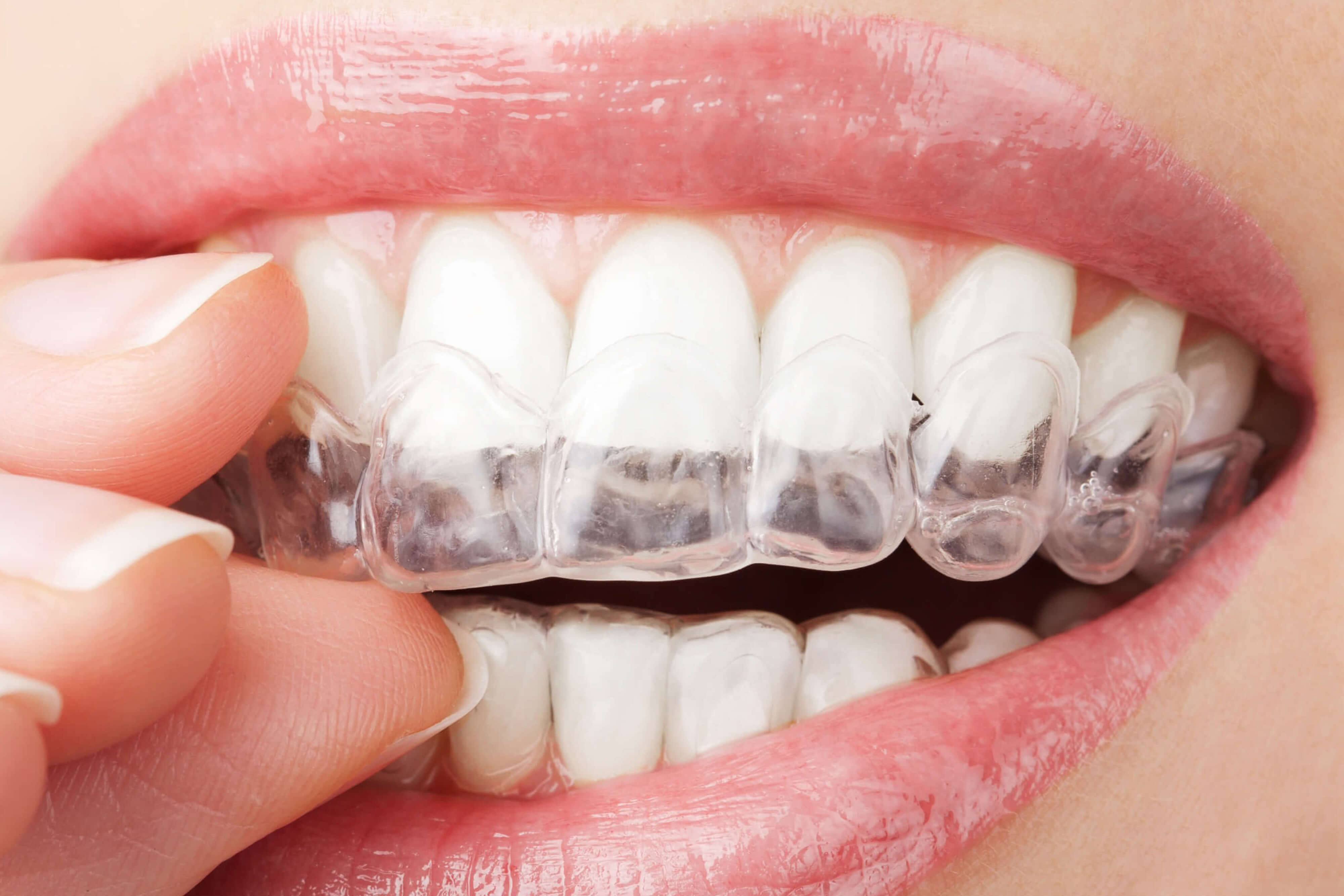 Keep Your Invisalign® Aligners Clean