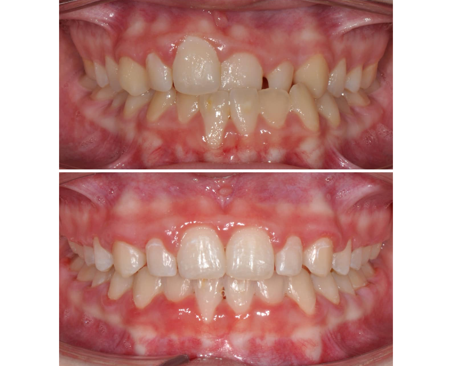 Inspired Orthodontics - Rapid Maxillary Expansion Results