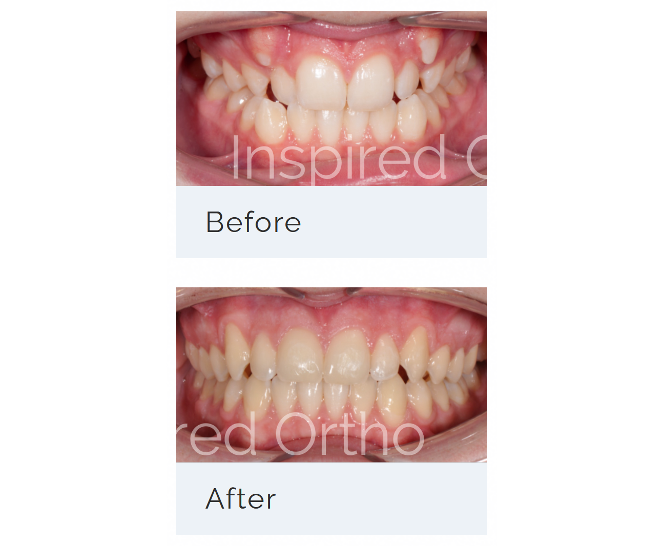 Non-Extraction Orthodontics with Maxillary Skeletal Expansion