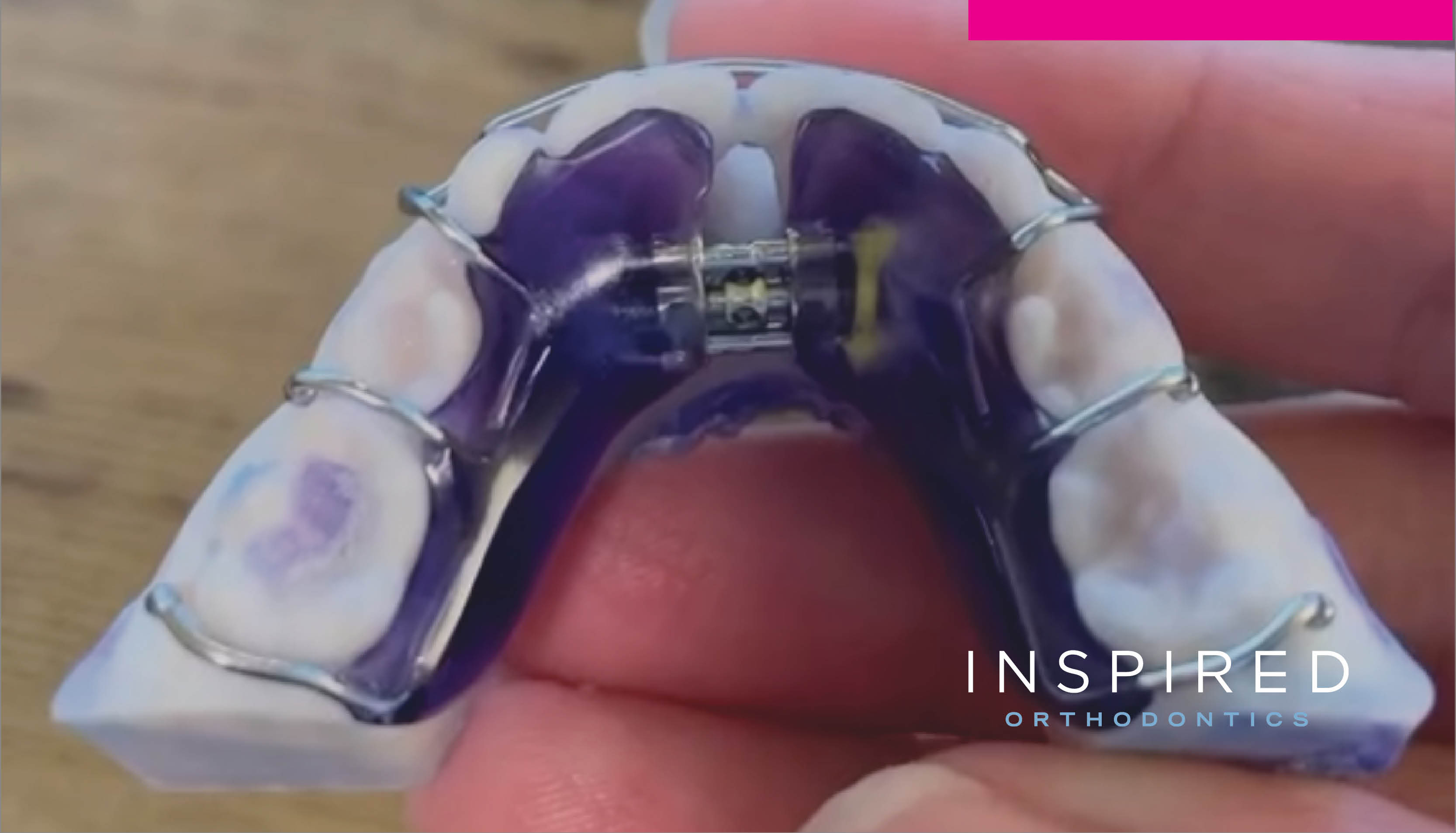 Gentle Expansion for Growing Smiles