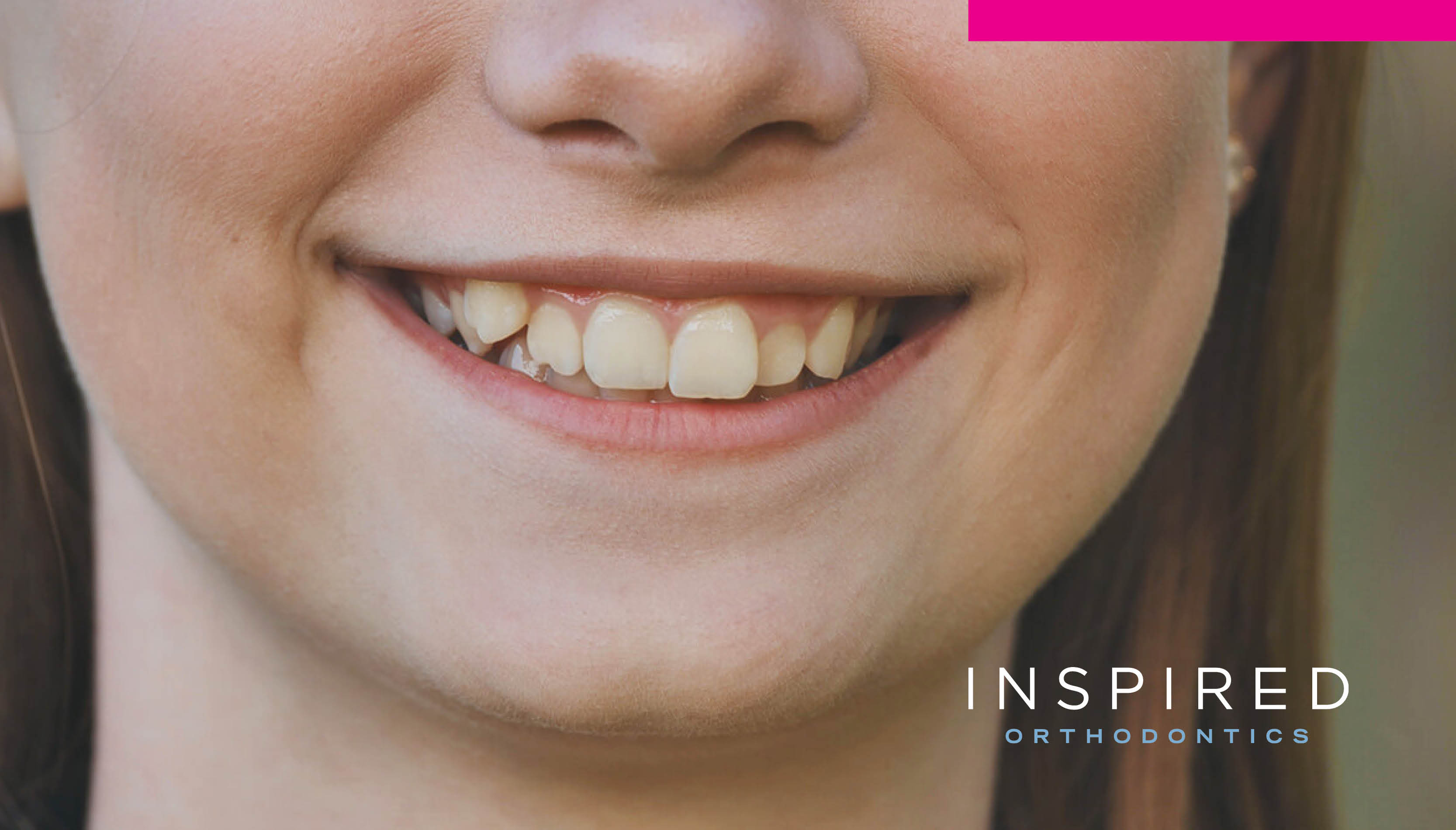 Dental Crowding in Children